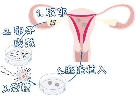 试管助孕生男孩